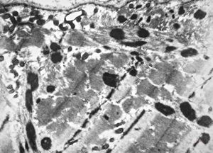 F,56y. | nemaline myopathy v.s.